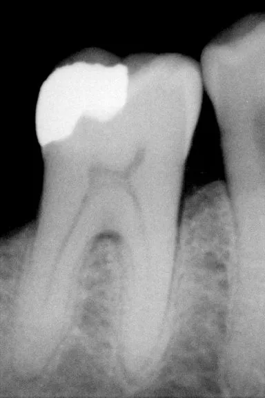 Radiograph of a molar with a large, completely radiopaque amalgam restoration